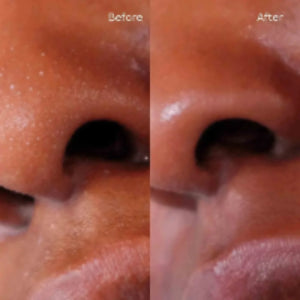 Before and after close-up of nose showing pore reduction using gentle facial exfoliator PritiPolish®